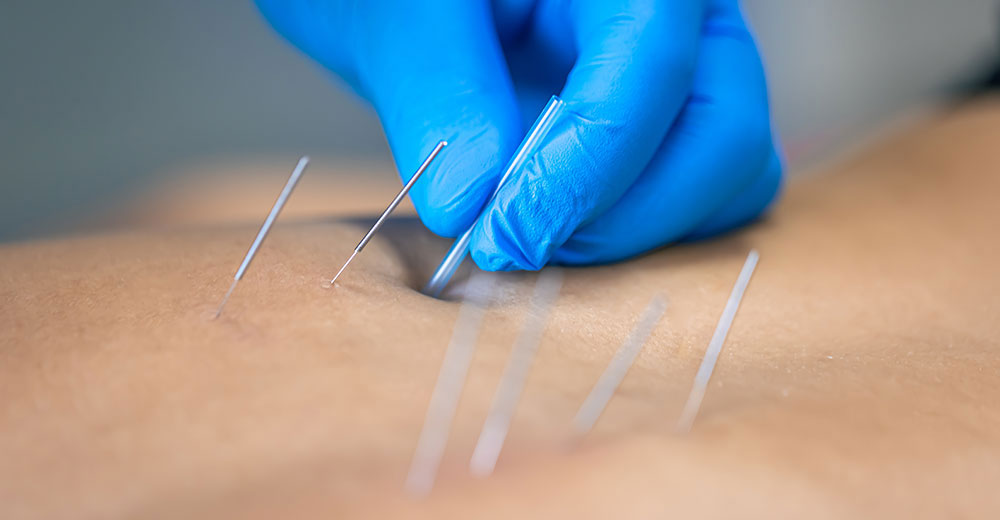 dry needling therapy